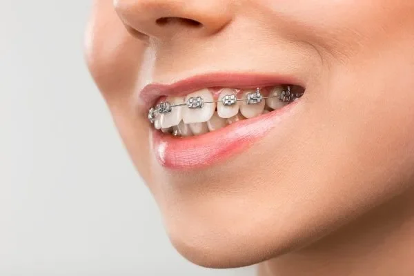 Dental braces